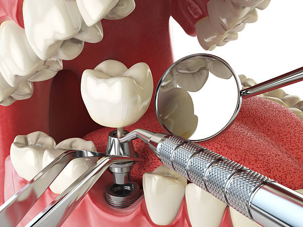 Best Urgent Care for Lost Fillings or Crowns in Traverse City, MI